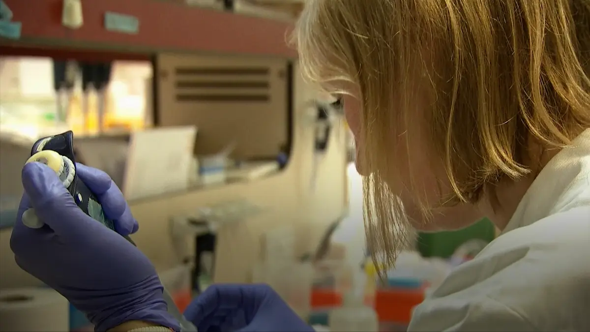 Transplantace Kostni Drene Pomohla Jiz Druhemu Cloveku Od Viru Hiv