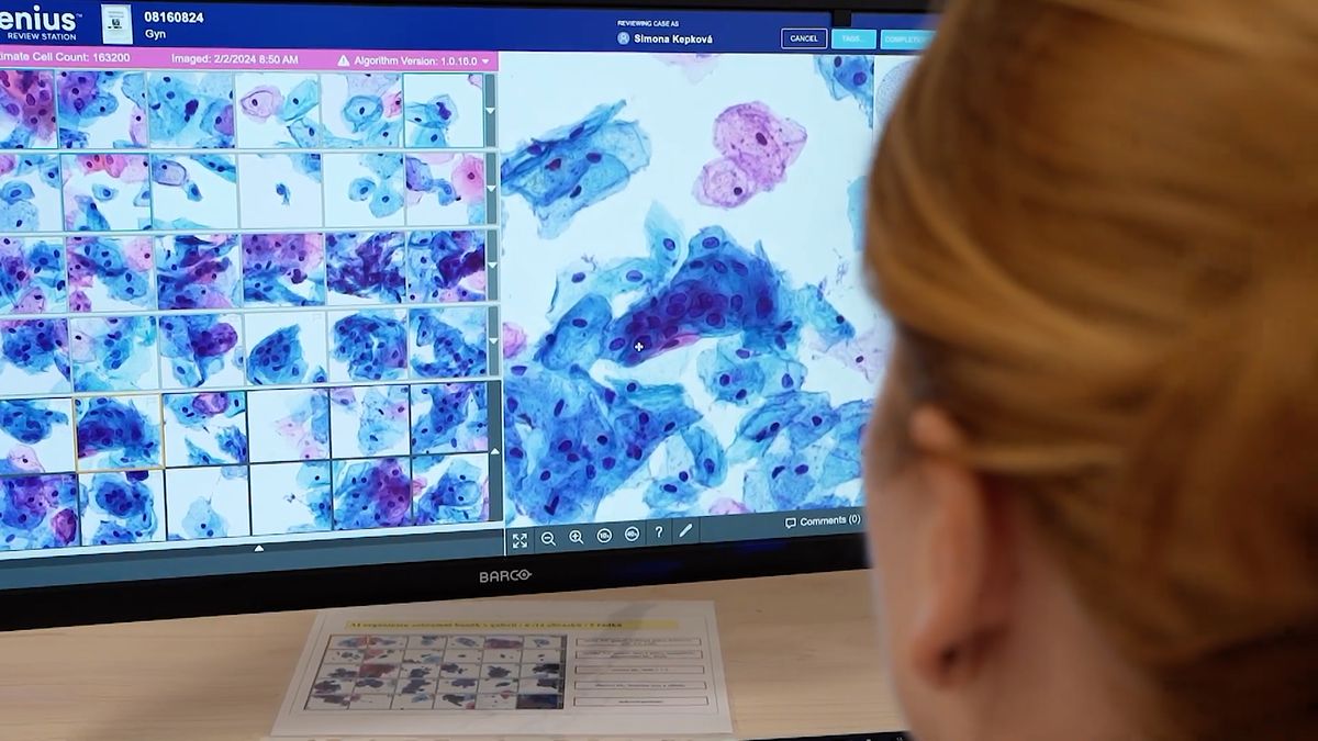 Rakovinu prostaty v největší evropské laboratoři v Plzni nově odhaluje AI