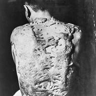 Podle japonských oficiálních údajů přesahuje celkový počet mrtvých z Hirošimy 260 tisíc. (Muž, který přežil výbuch atomové bomby v Nagasaki. Vláknité výrůstky mu přerůstají přes zjizvenou tkáň.)