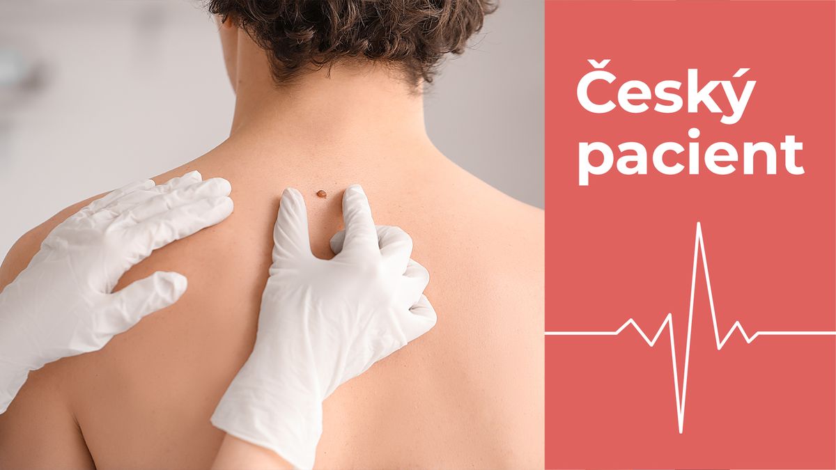 Melanomů přibývá. Nové znaménko v 50 letech je podezřelé vždy. Jak ho poznat