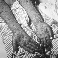 Jedná se o vysoce nakažlivé virové onemocnění způsobené virem variola. Projevuje se horečkou a typickou hnisavou vyrážkou, která zanechává jizvy a často vedla k úmrtí. 

(Pacient s neštovicemi, epidemie v Kosovu, Jugoslávie, březen a duben 1972.)